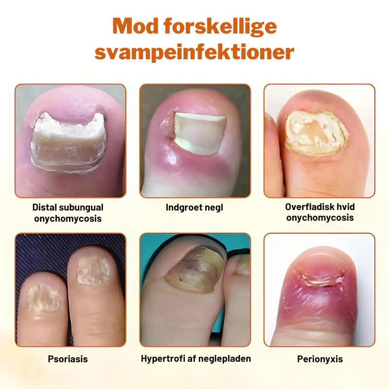 FungiStop – Spray de Cuidado de Uñas Antifúngico Avanzado