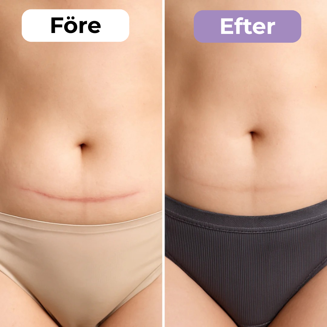 SilkoLapp™ - Protección suave para una piel más suave