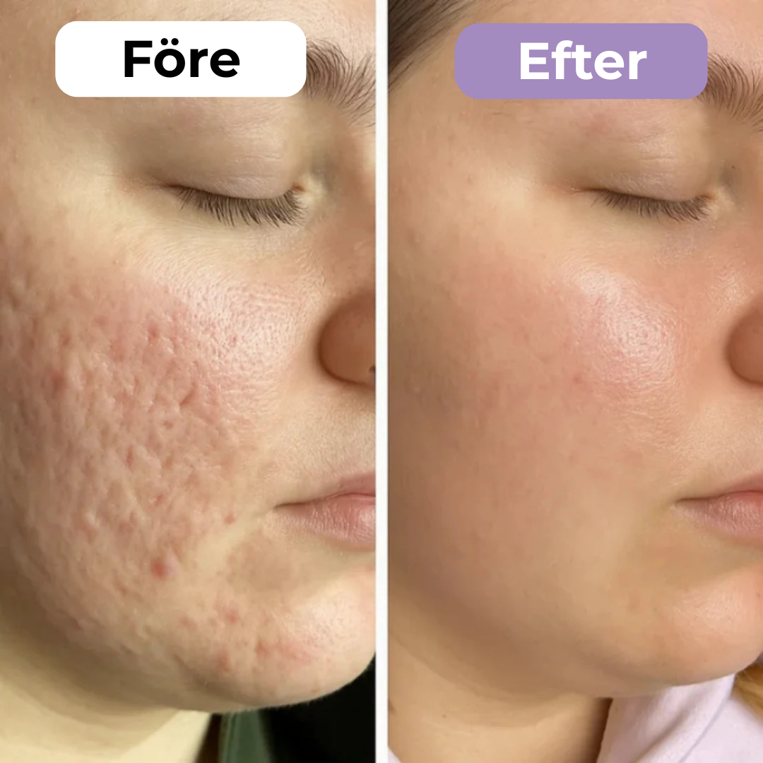 SilkoLapp™ - Protección suave para una piel más suave